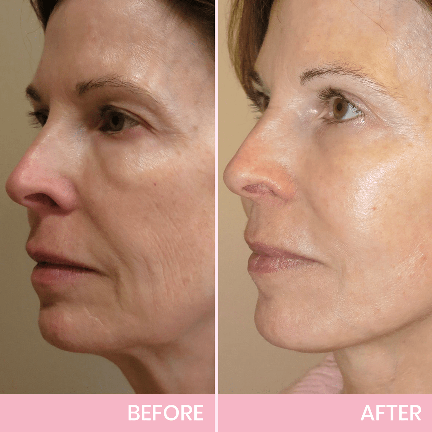 🎉NEW YEAR SALE - 50% OFF!🎁Give the Gift of Beauty in 2025 with BBOJI™ V-Face Tape for a Stunning Look.💄Hurry Now!🐰