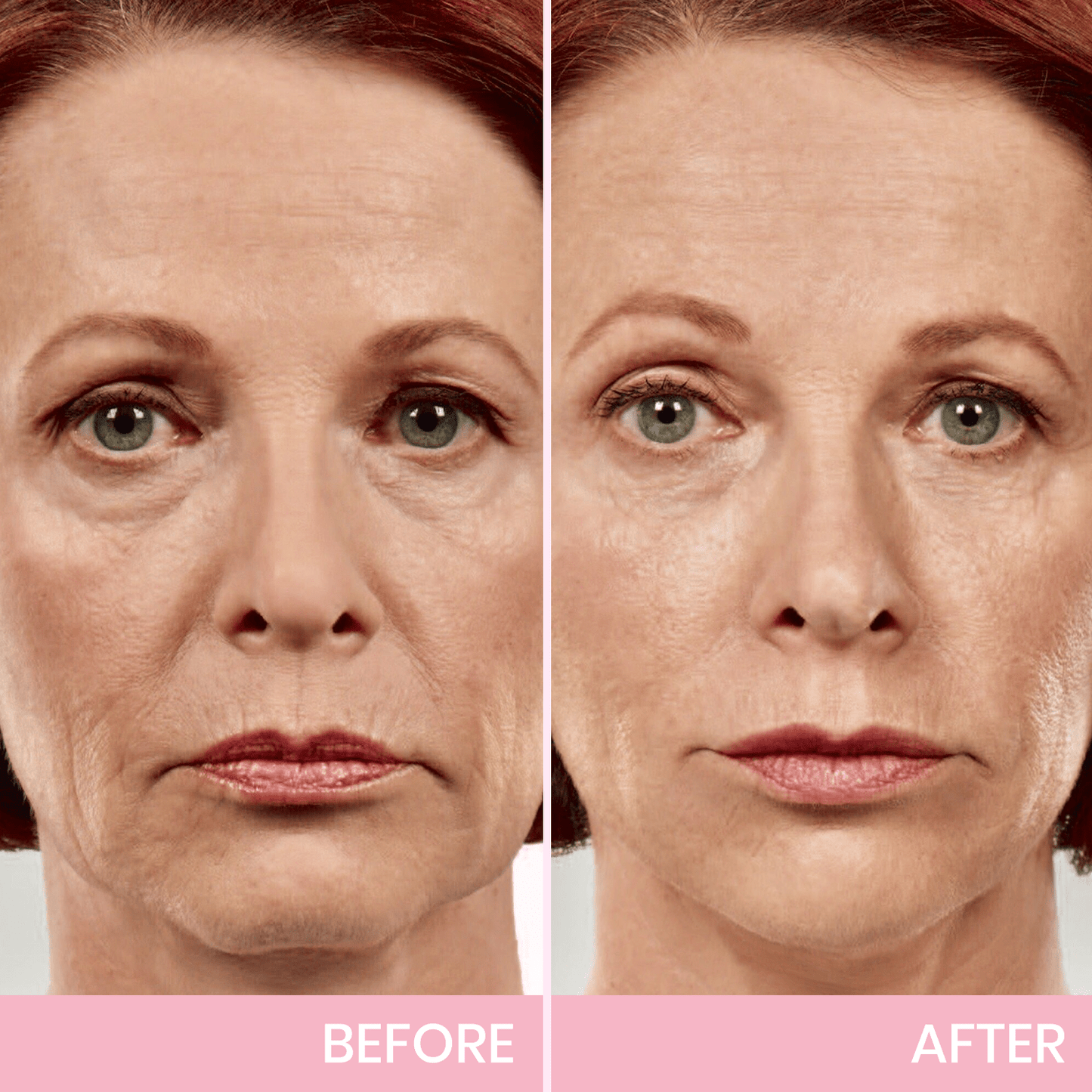 🎉NEW YEAR SALE - 50% OFF!🎁Give the Gift of Beauty in 2025 with BBOJI™ V-Face Tape for a Stunning Look.💄Hurry Now!🐰